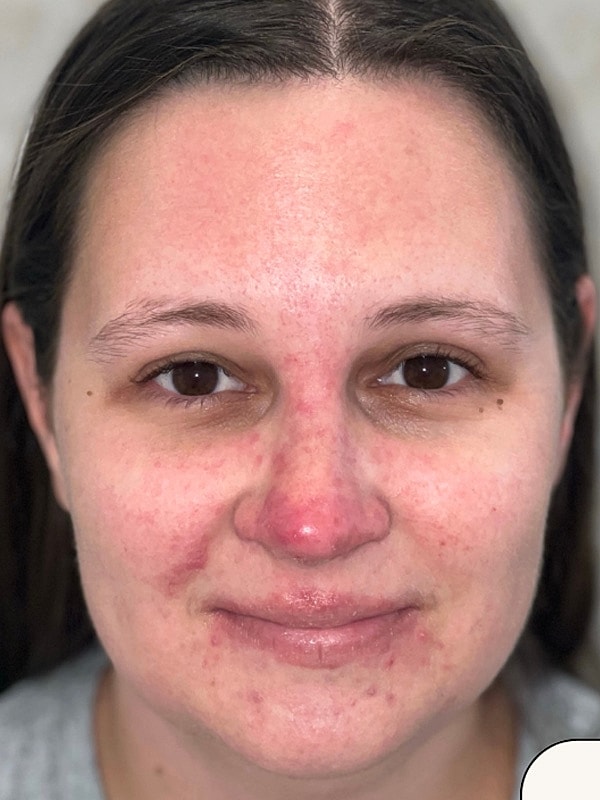 Laser Toning Gallery Before & After