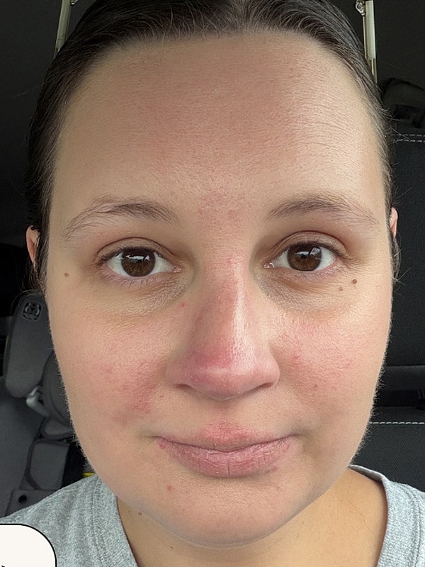 Laser Toning Gallery Before & After