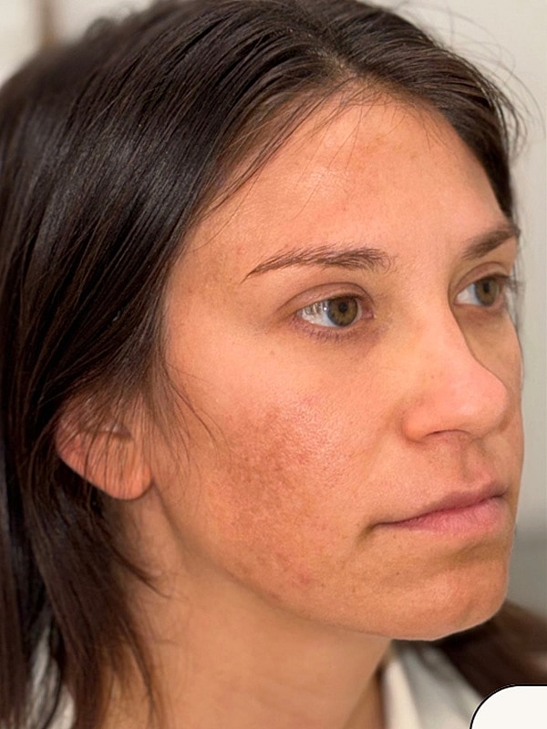 Facial Balancing Gallery Before & After