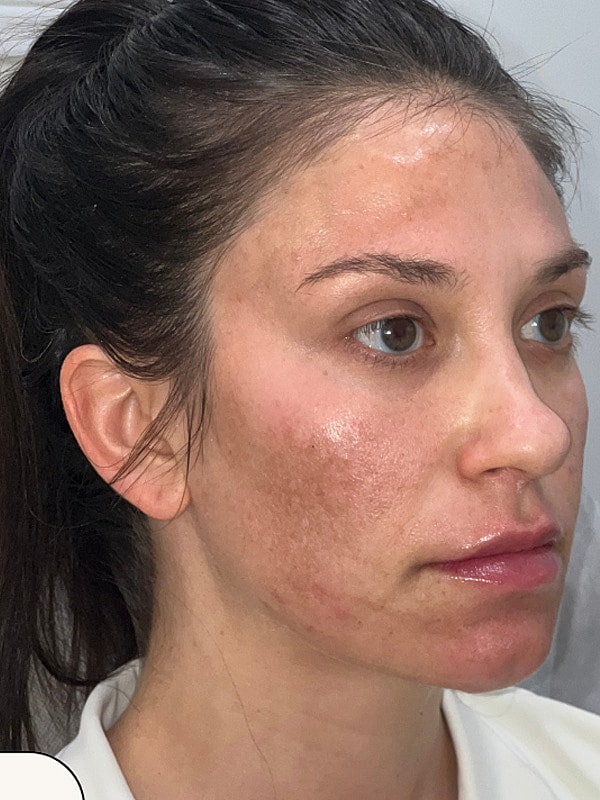 Facial Balancing Gallery Before & After