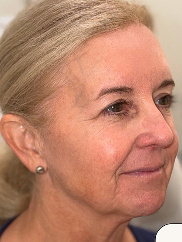 Facial Balancing Gallery Before & After