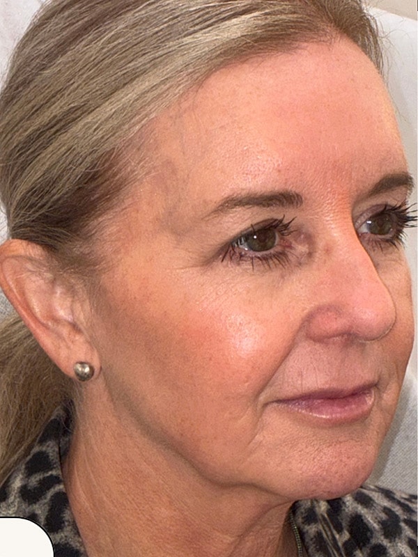 Facial Balancing Gallery Before & After