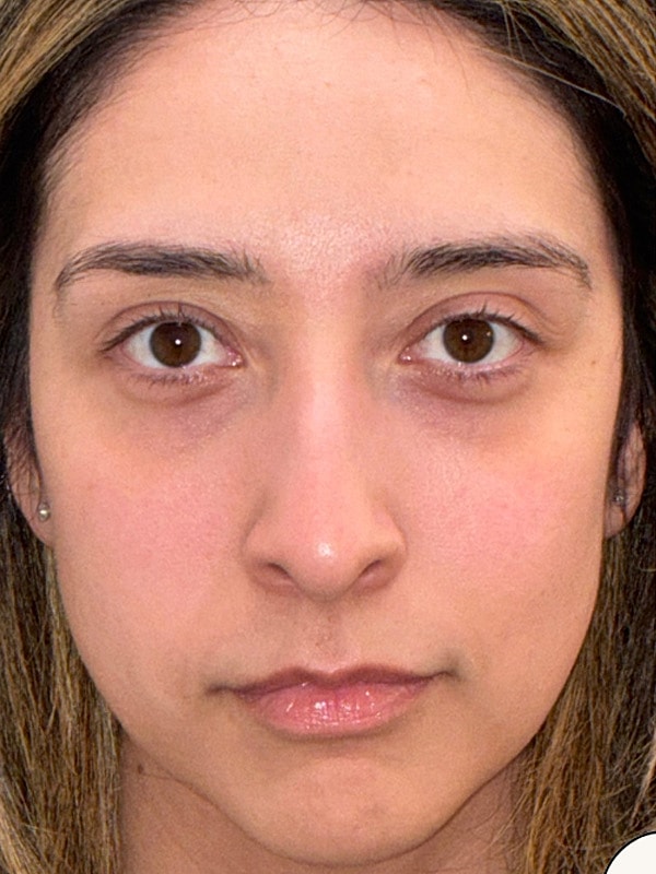 Chin Filler Gallery Before & After
