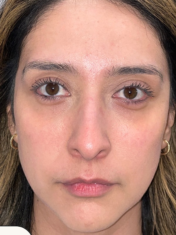 Chin Filler Gallery Before & After