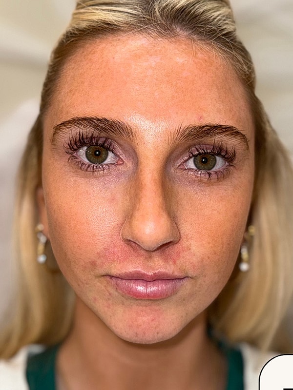 Lip Filler Gallery Before & After