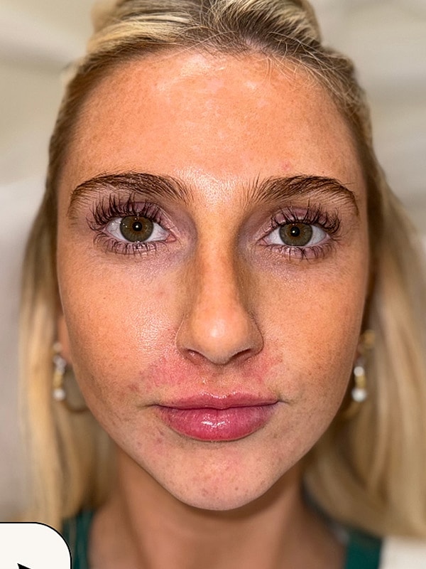 Lip Filler Gallery Before & After