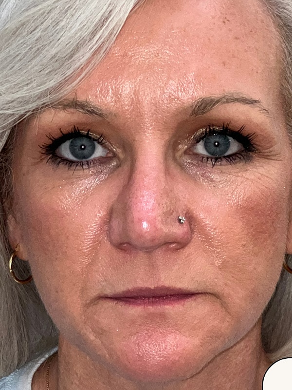 Lip Filler Gallery Before & After