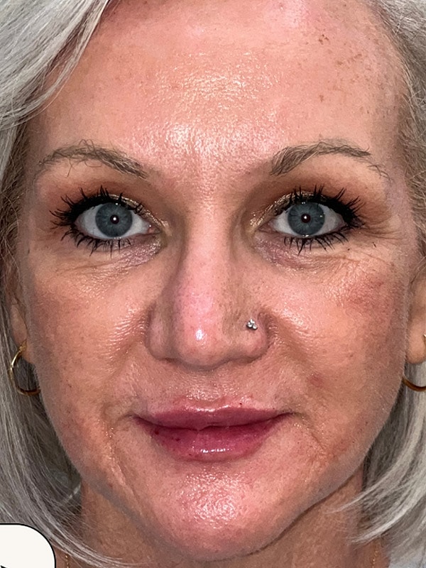 Lip Filler Gallery Before & After