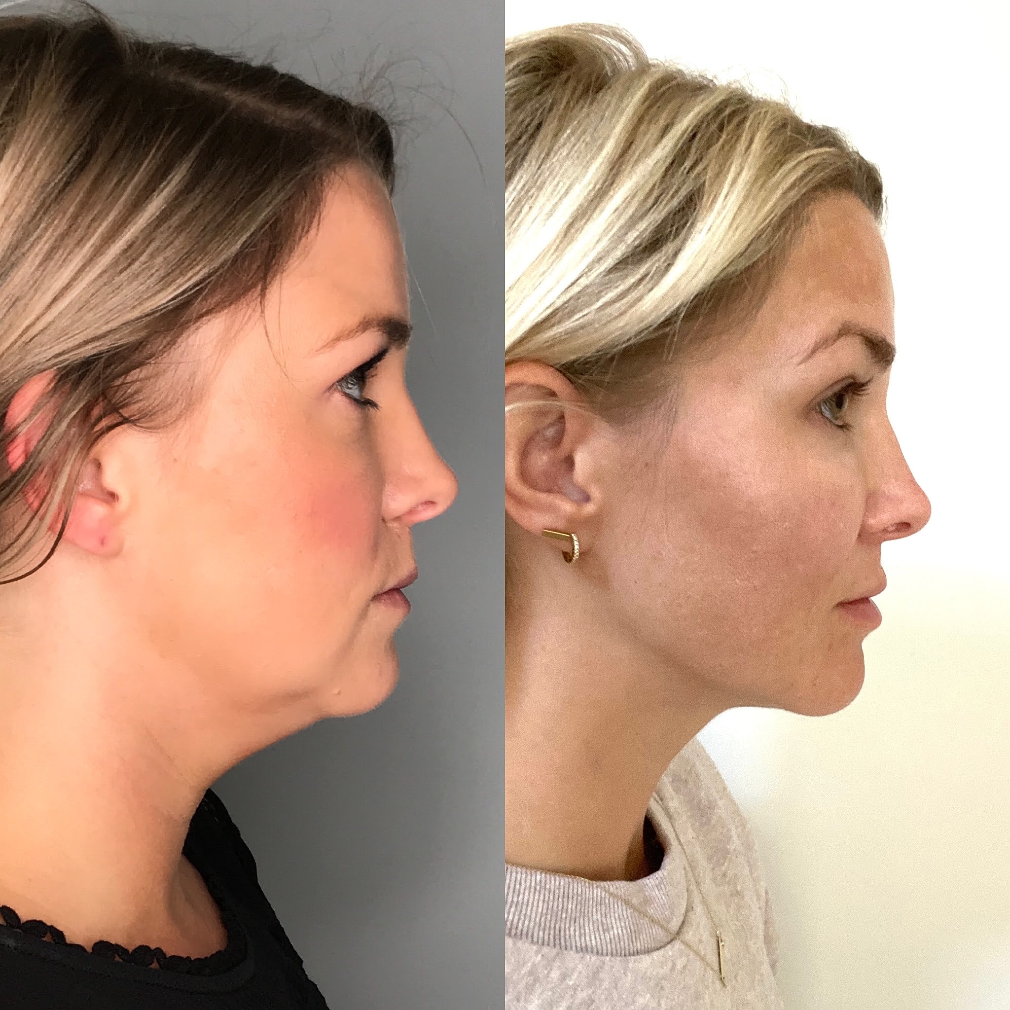 The truth about my double chin!
