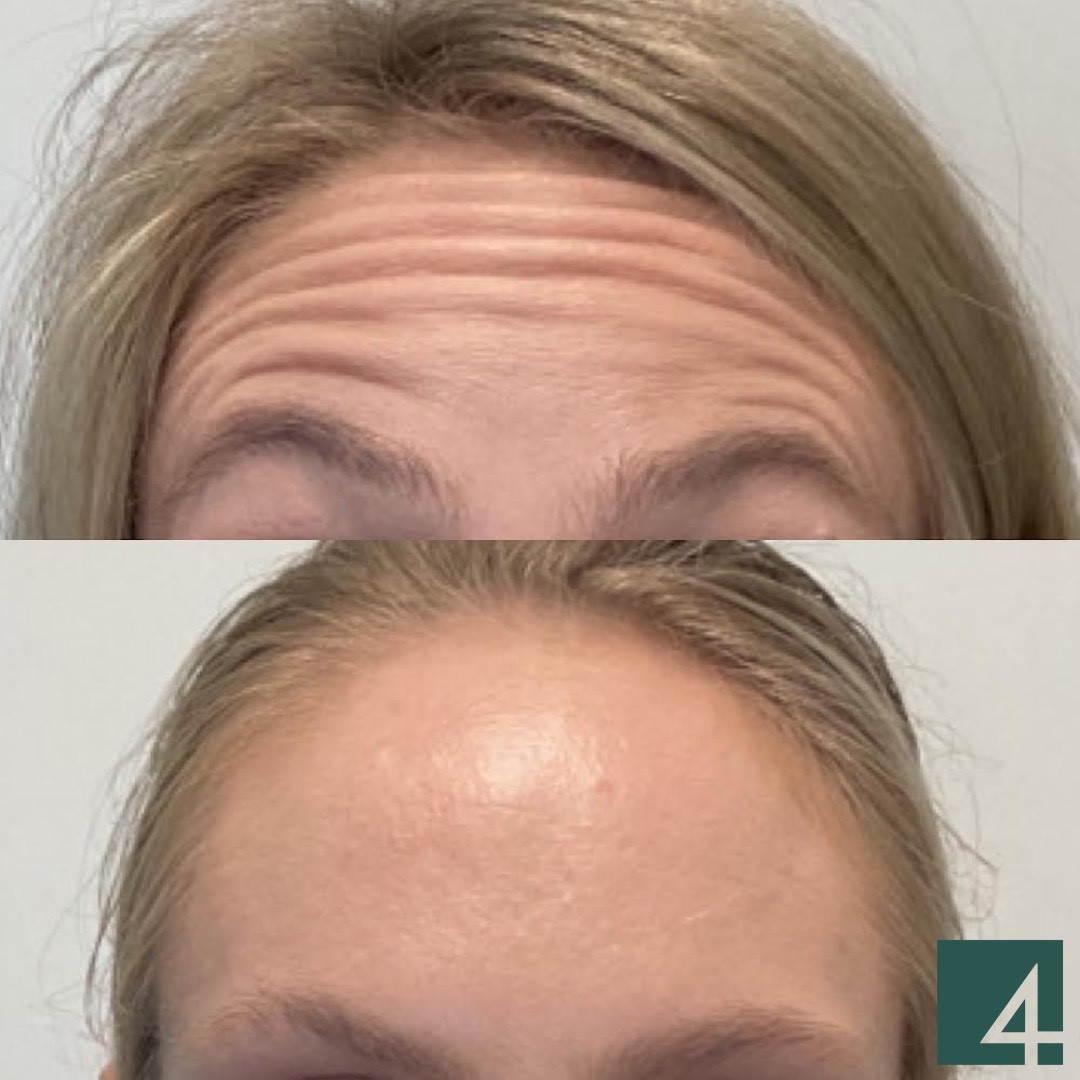 forehead line toxins before and after