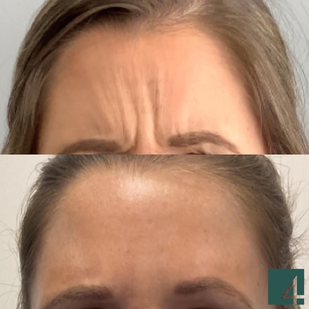 forehead line toxins before and after