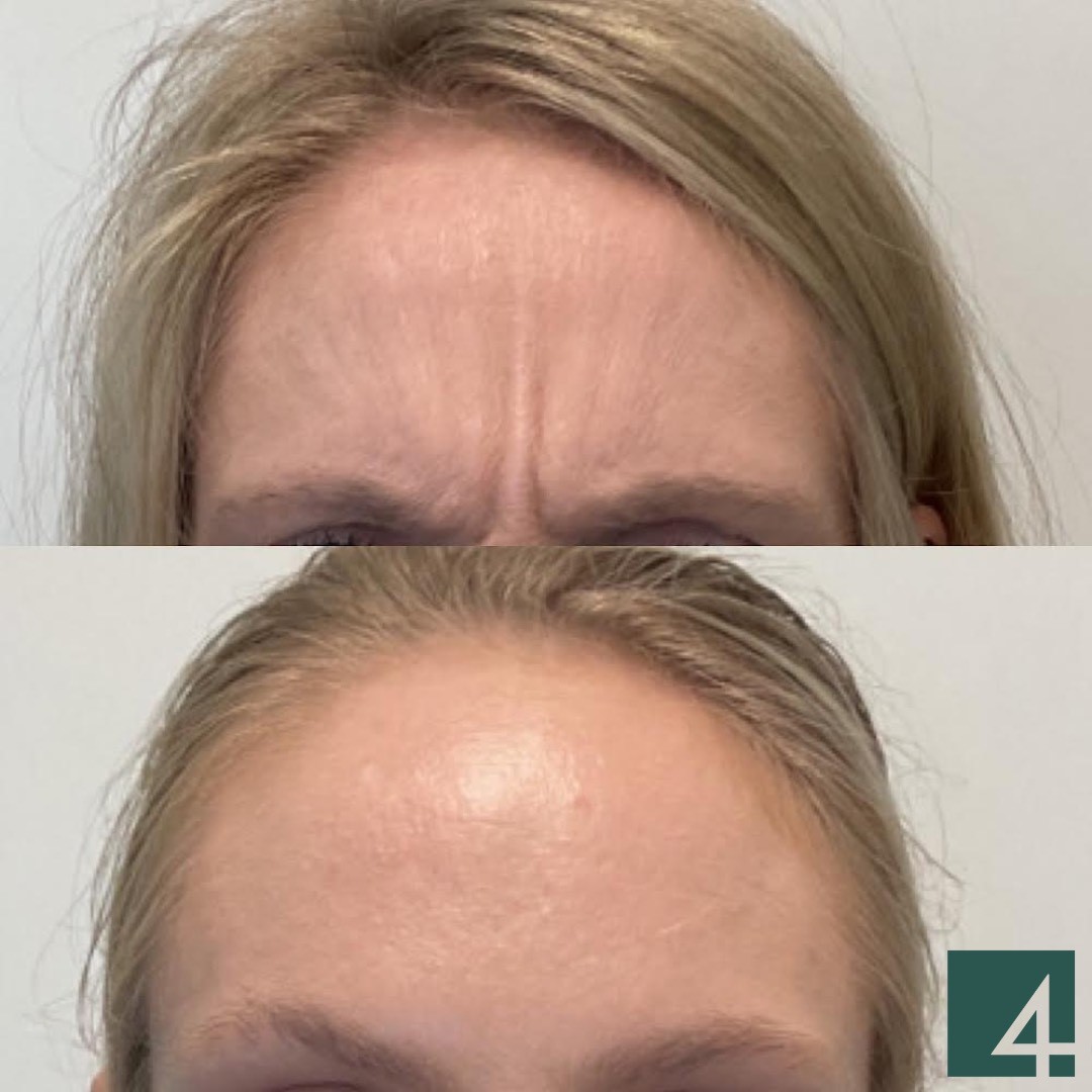 forehead line toxins before and after