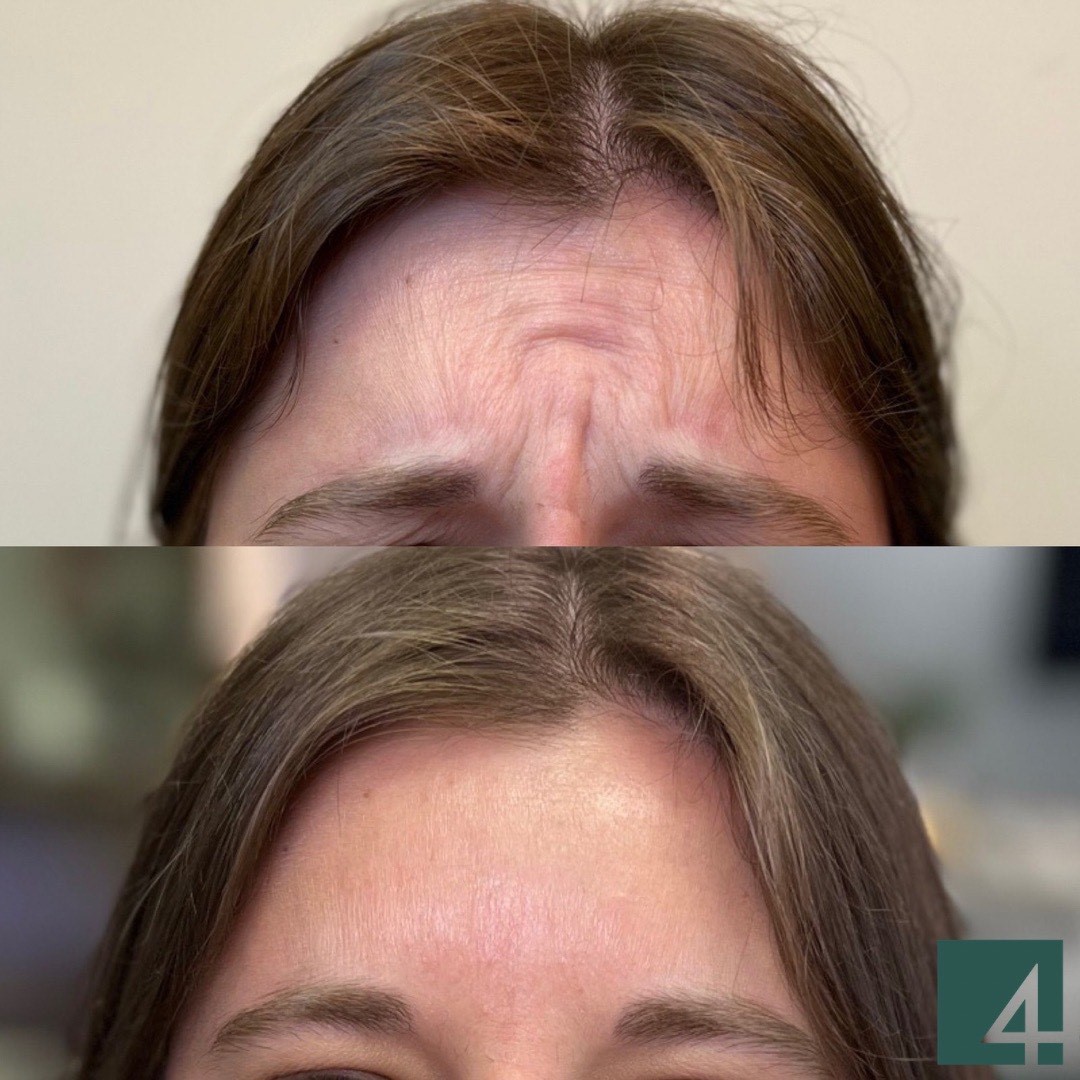 forehead line toxins before and after