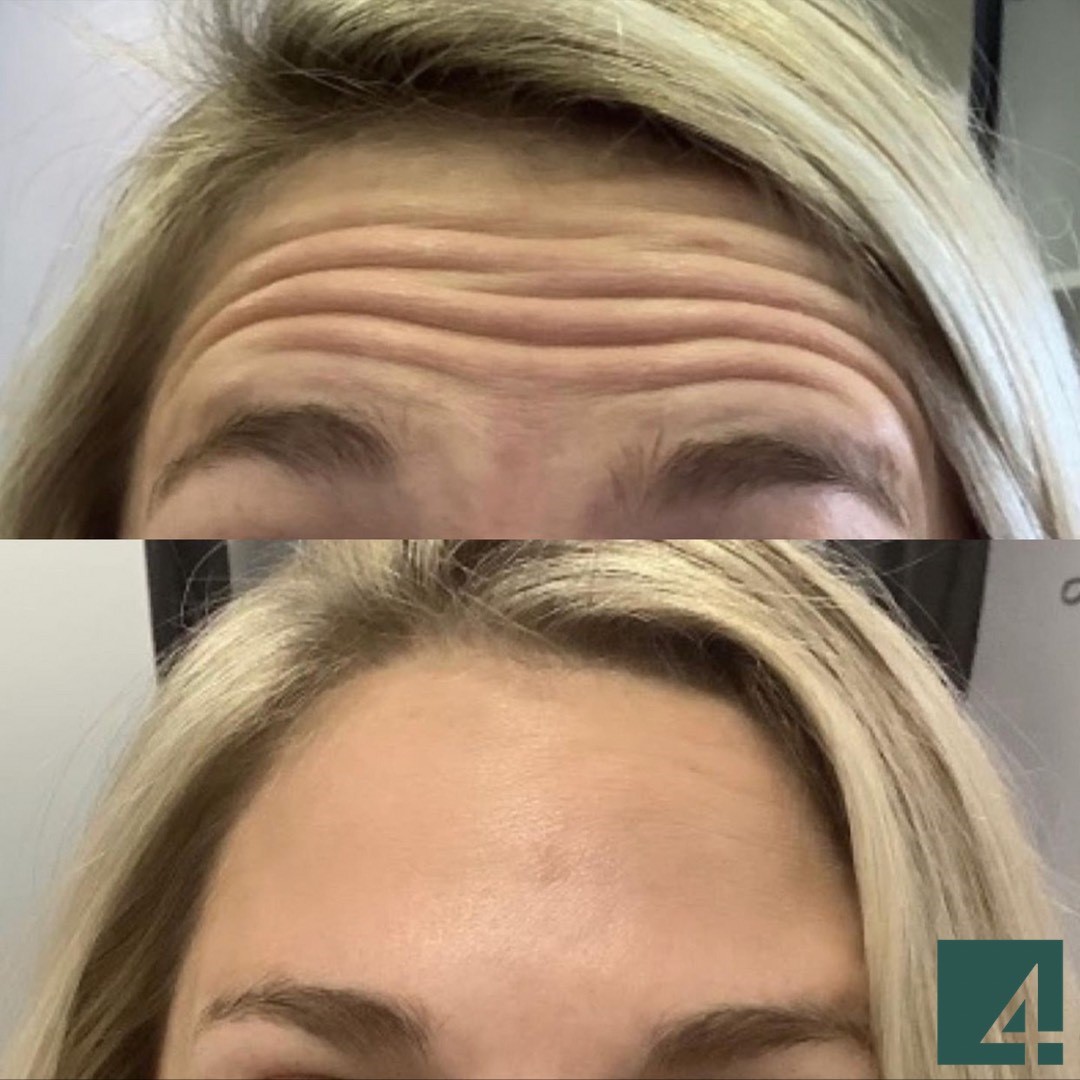 forehead line toxins before and after