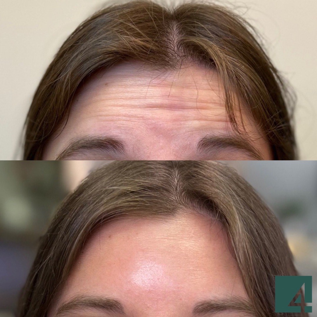 forehead line toxins before and after