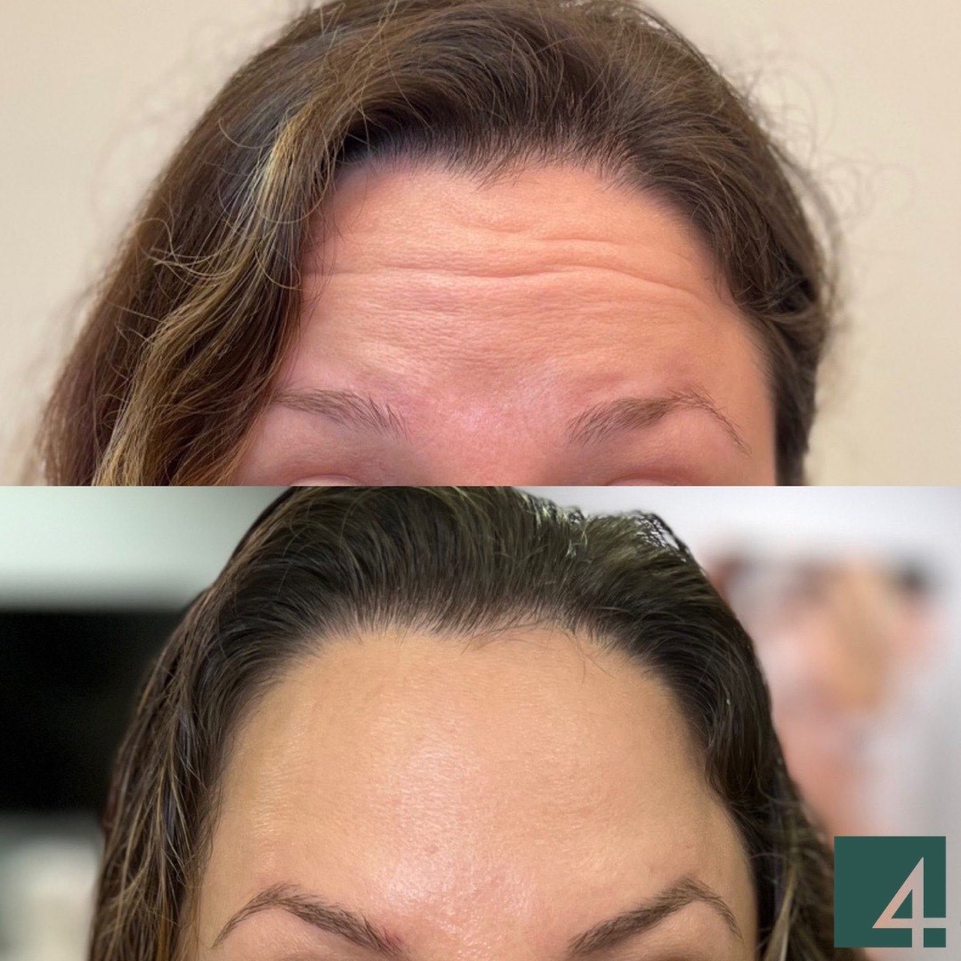 forehead line toxins before and after