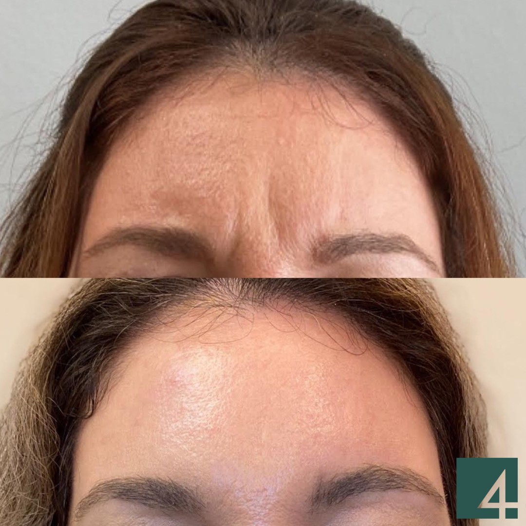 forehead line toxins before and after