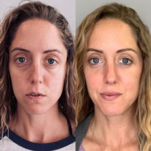 Before and After, Safe & Effective Fillers